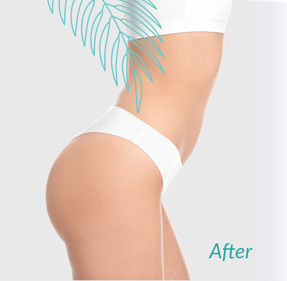 Cellulite Reduction After