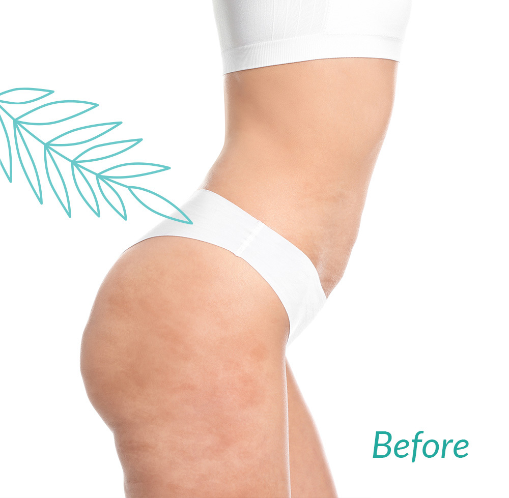 Cellulite Reduction Before