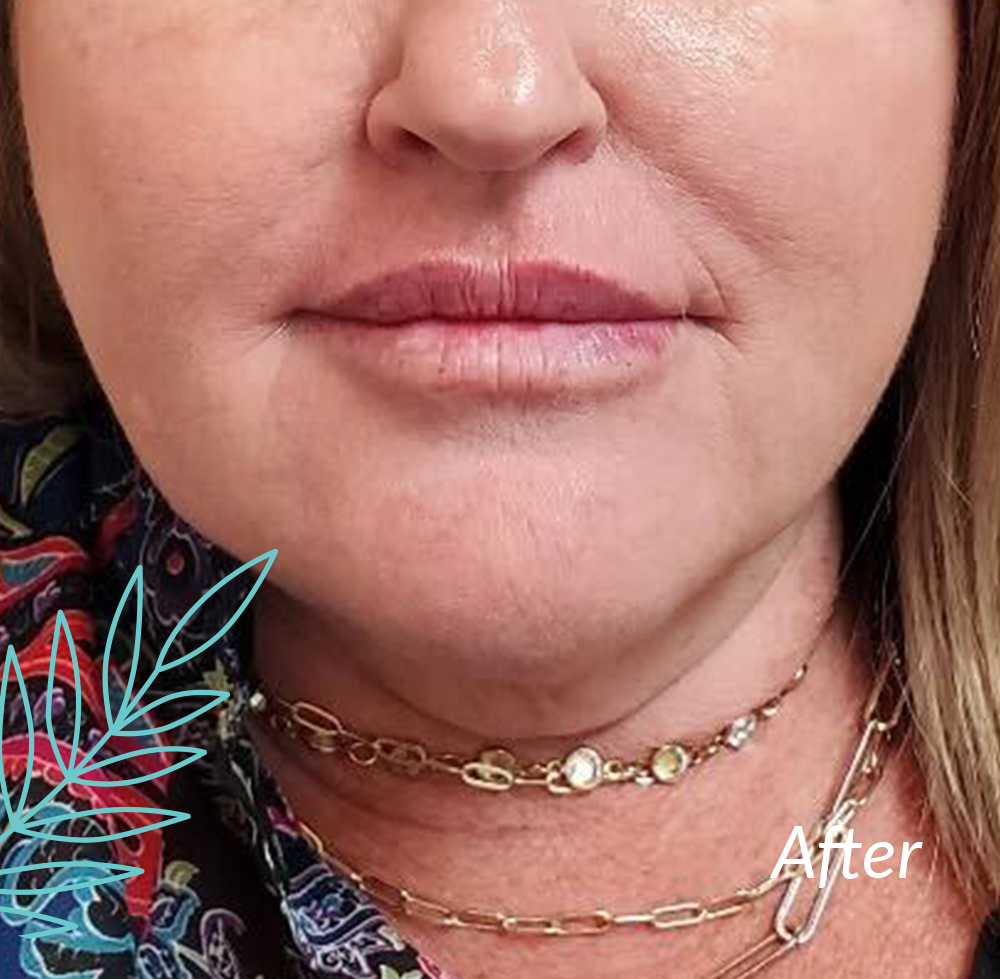 Solas Cosmetic Injectable after