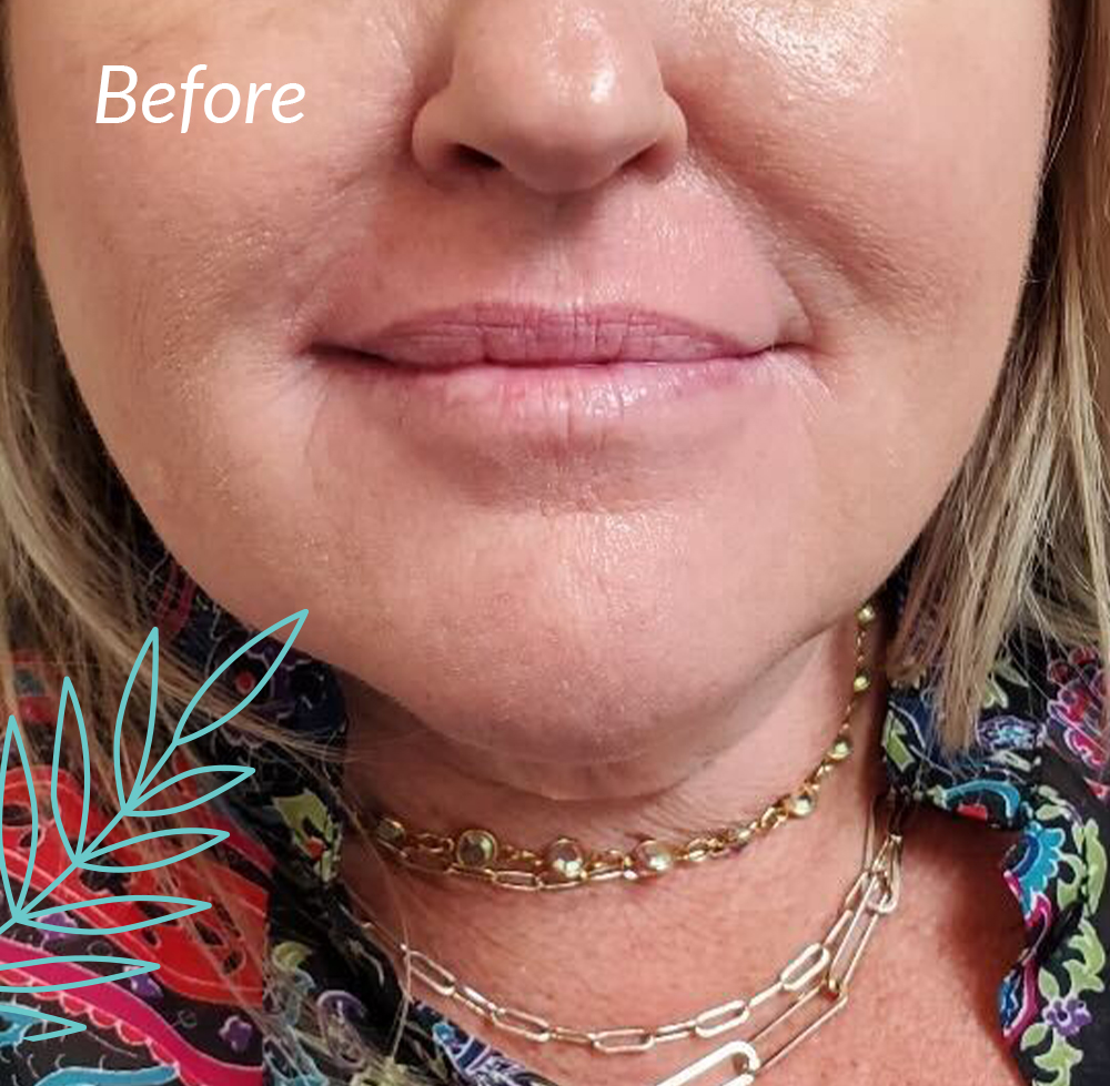 Solas Cosmetic Injectable before