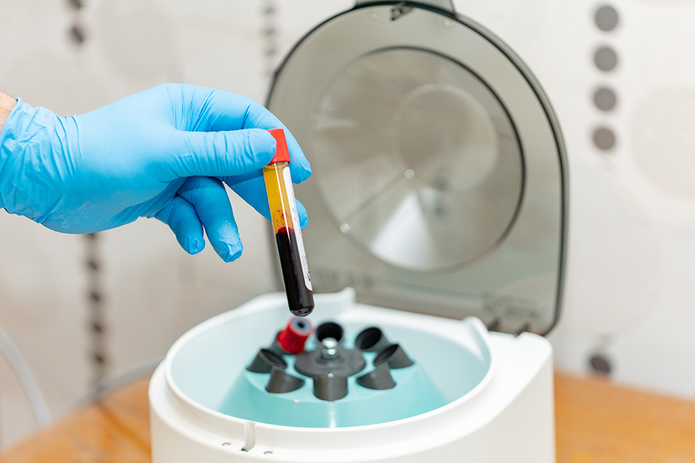 PRP therapy centrifuge